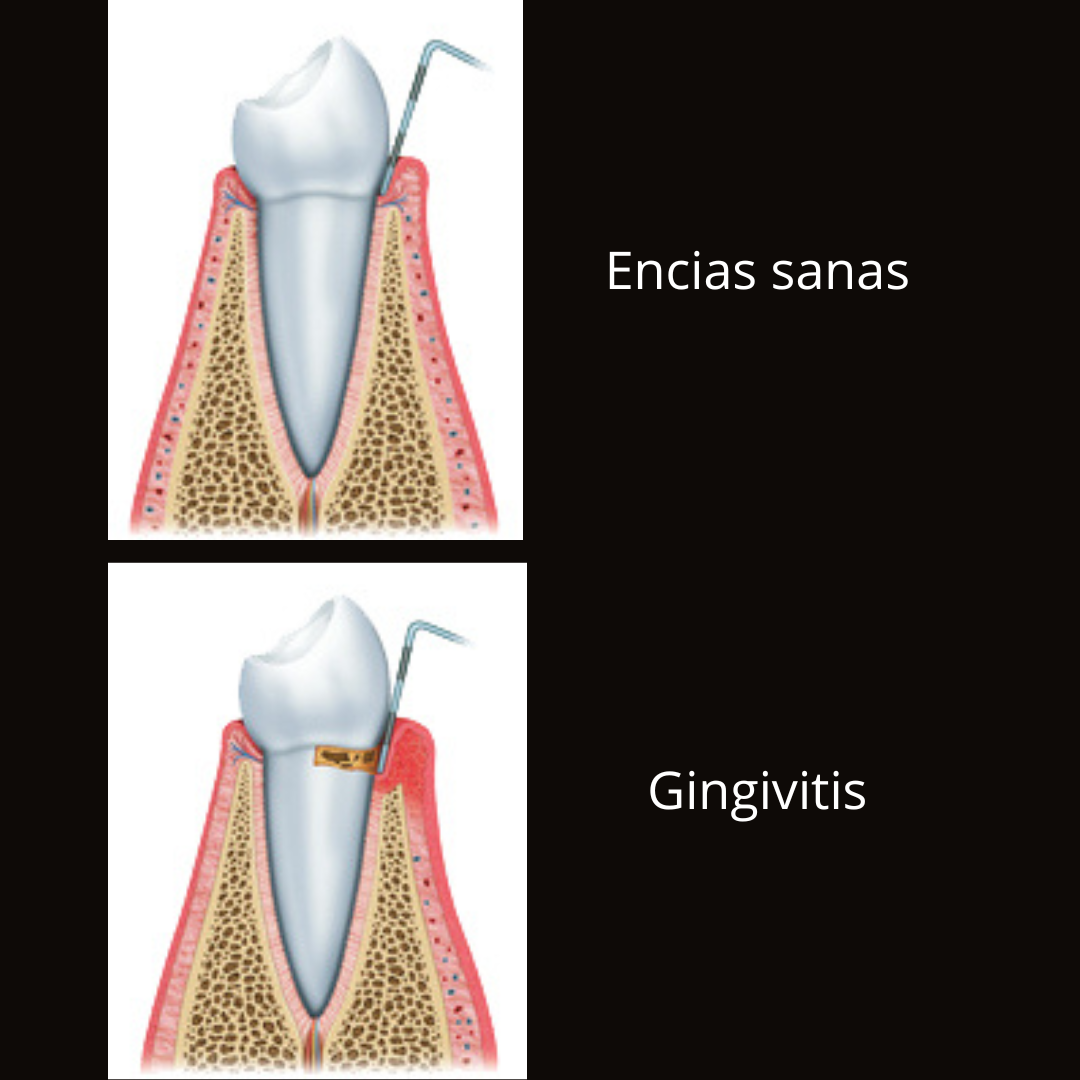 Progresion enfermedad 2