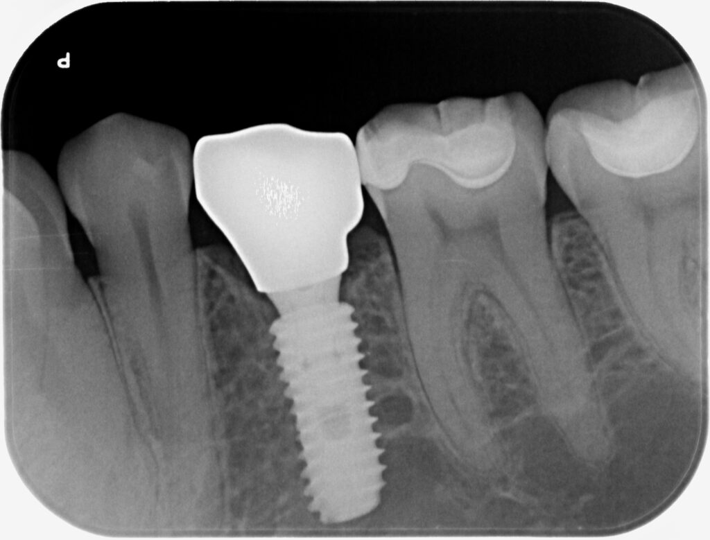 implantes dentales viña del mar