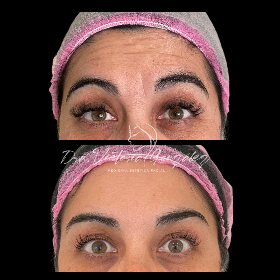 botox-antes-despues-1