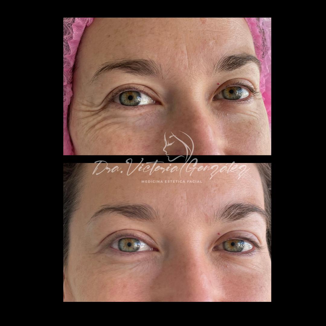 botox-antes-despues-2