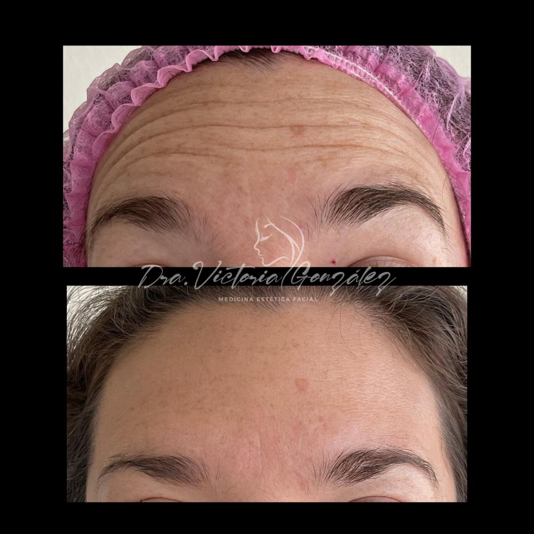 botox-antes-despues-3