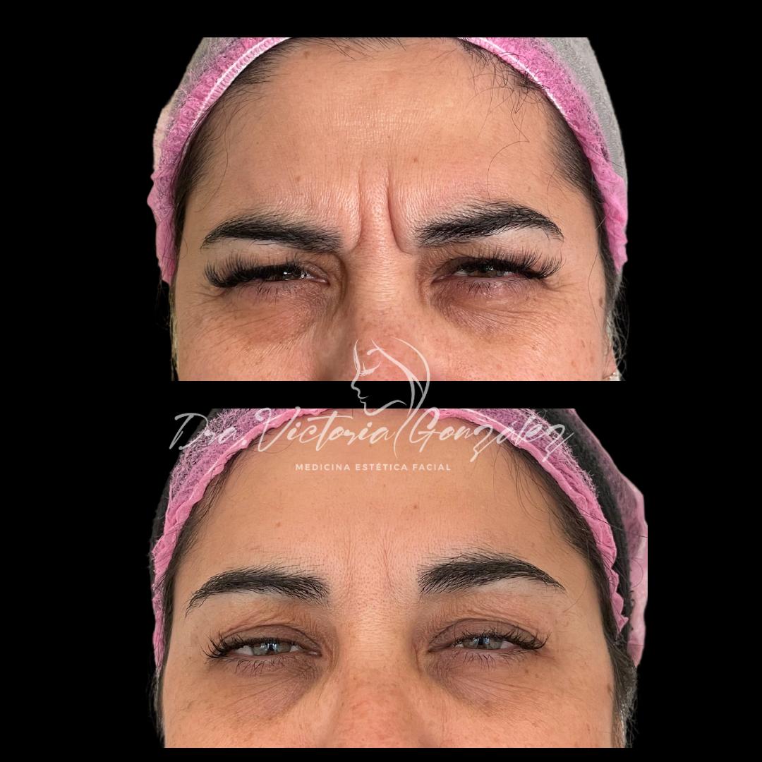 botox-antes-despues-4