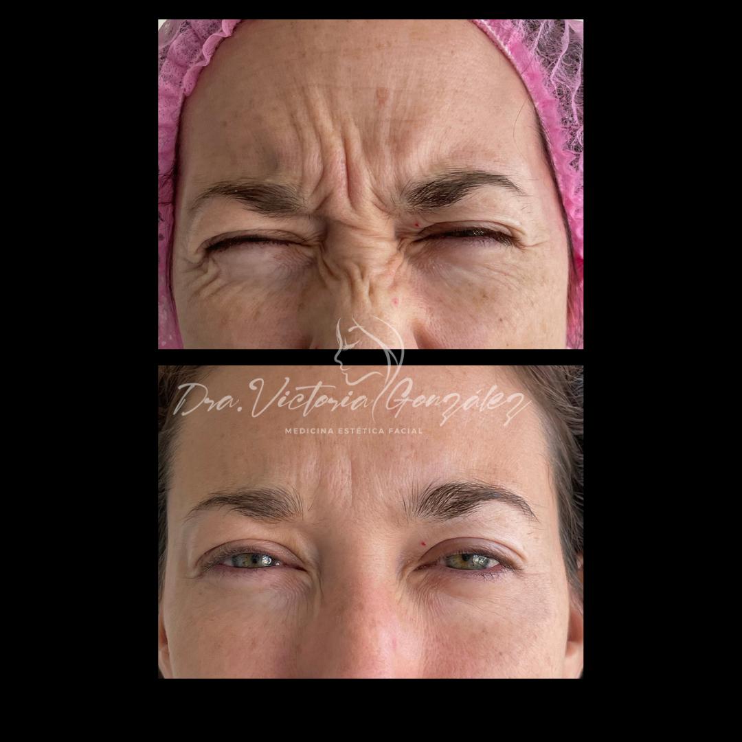 botox-antes-despues-5