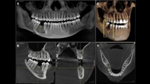scaner diagnostico implante dental viña del mar