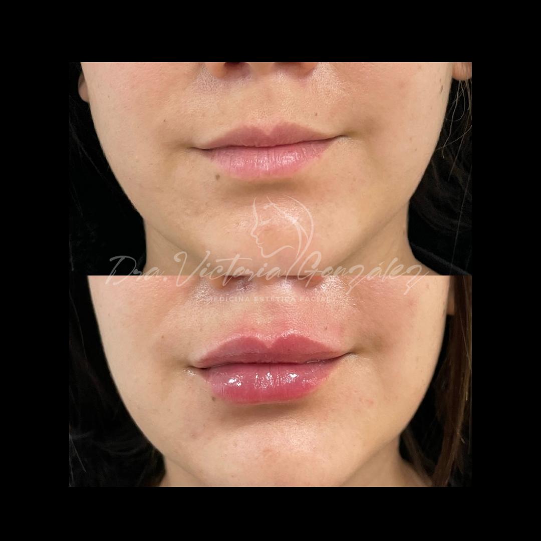 perfilado-labios-antes-despues