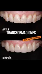 diseño de sonrisa caso